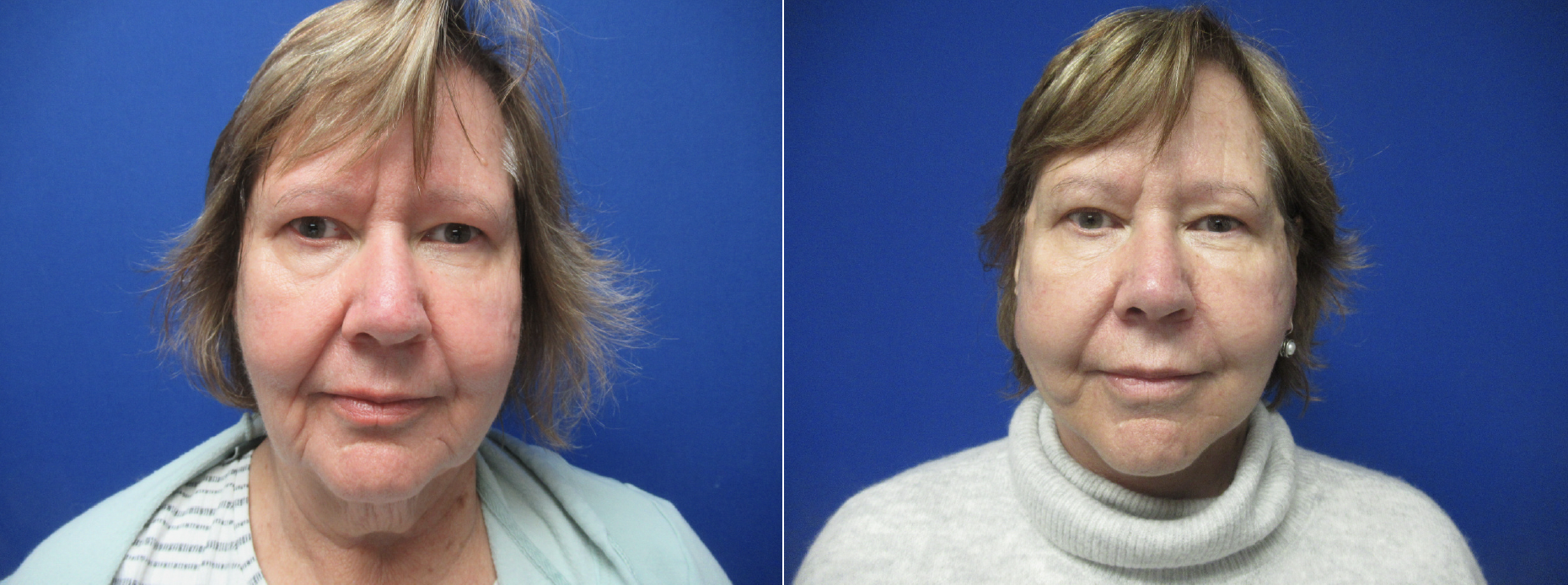 Facelift Before and After